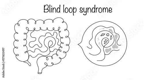 Blind loop syndrome