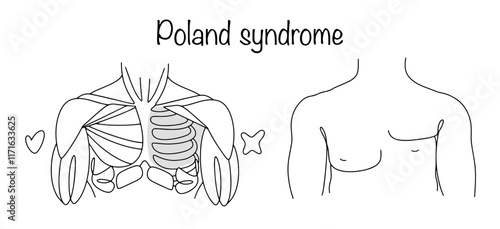 Poland syndrome