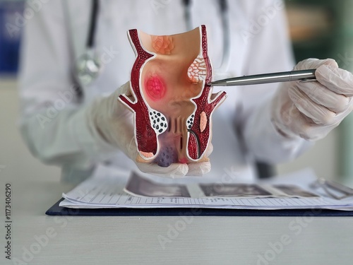 Tableau sur toile Medical sciences showing diseases of rectum on artificial model of human organ c