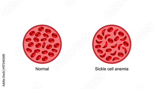 Sickle cell anemia. Normal red blood cells and sickle cells. Vector illustration isolated on white background.
