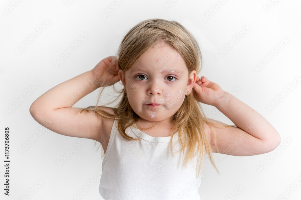Face of a little girl with chickenpox, antiseptic cream applied to the rash. Viral disease in children. Face of a little girl with chickenpox, antiseptic cream applied to the rash. Viral disease in children.