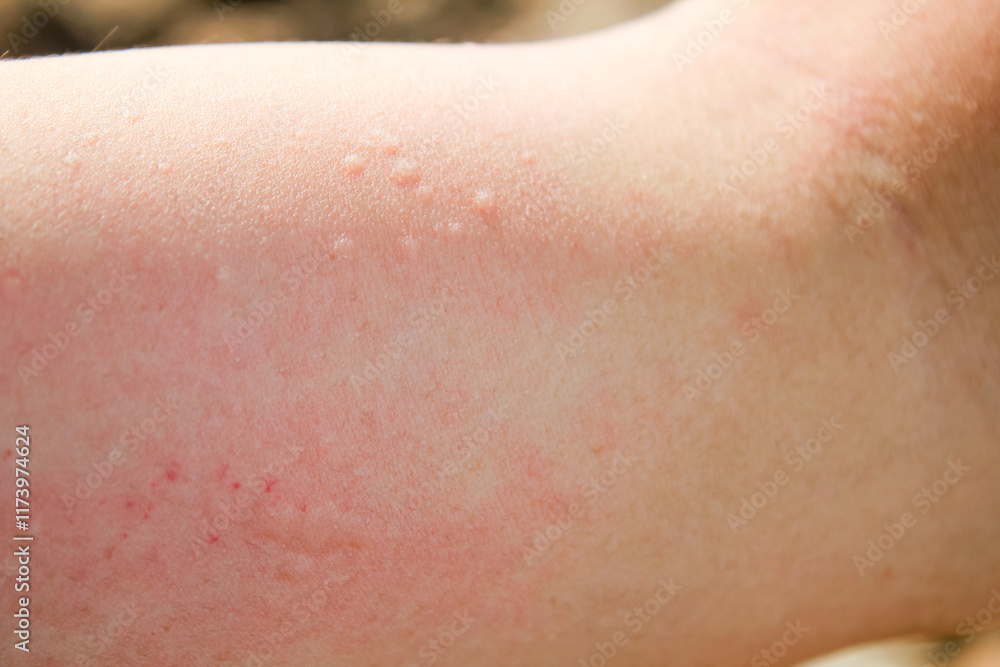 Fototapeta premium Allergy Skin rash appears red and itchy on the man's arm