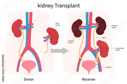 Donor and recipient of Kidney transplantation for end stage renal failure