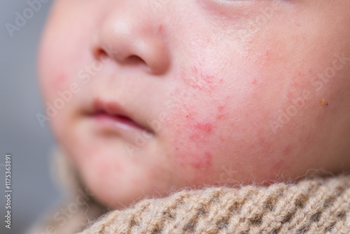 Baby cheeks with visible eczema and rash photo