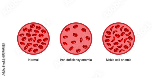 Iron deficiency anemia. Sickle cell anemia. Vector illustration isolated on white background.