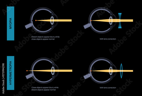 Farsightedness and nearsightedness correction