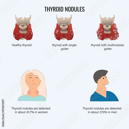 
Thyroid Nodules and Nodular Goiter – Healthy, Single, and Multinodular Goiter Illustration