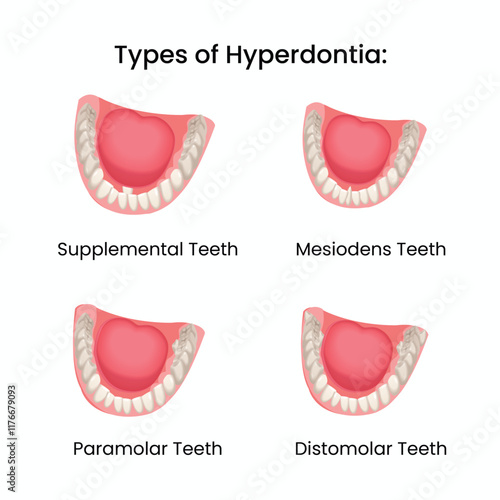 Types of Hyperdontia Vector Illustration – Supplemental, Mesiodens, Paramolar, and Distomolar Teeth Diagram