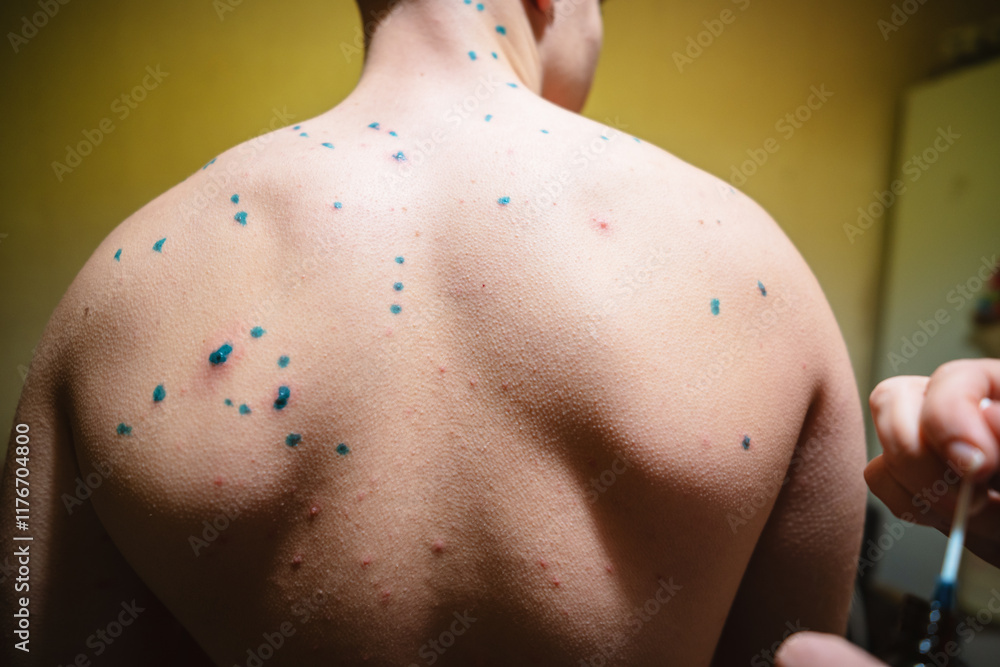 Fototapeta premium Applying Green Solution to Chickenpox Rash on Teenager's Back.