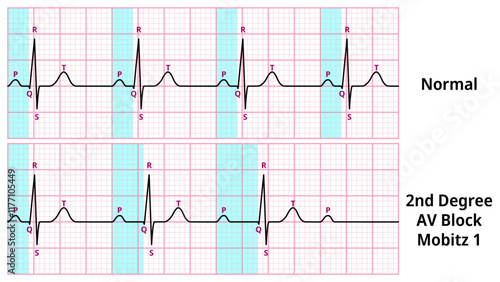 Comparison of AV Block Degree 2 Mobitz type 1 and Normal ECG Waveforms - Medical Vector Illustration