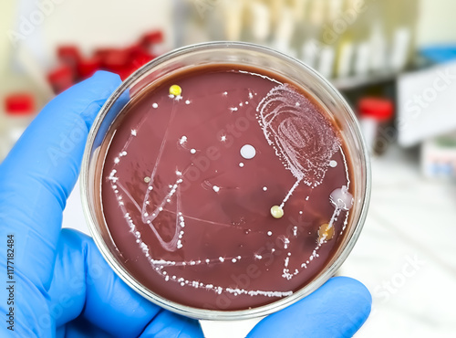 Gloved medical or scientific hand, with a microbiological culture of Candida colony an antimicrobial resistant pathogen.