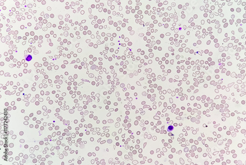 Hematological slide of Microscopic image showing severe microcytic hypochromic anemia. nRBC, Tear drop cell and others abnormal RBC present.  photo