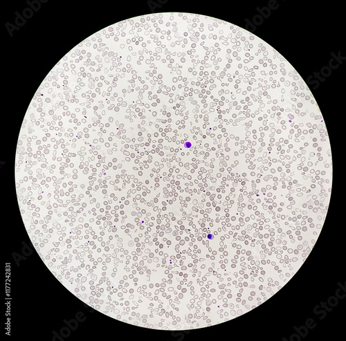 Hematological slide of Microscopic image showing severe microcytic hypochromic anemia. nRBC, Tear drop cell and others abnormal RBC present.  photo