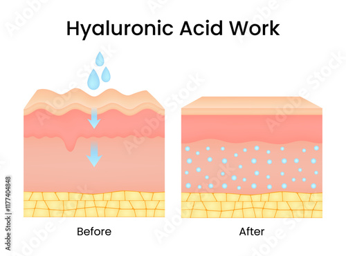 Hyaluronic acid work on skin