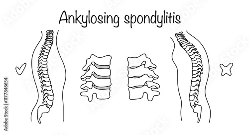 Ankylosing spondylitis