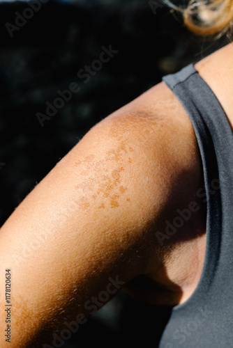 Close-up of actinic keratosis (AK) on the skin of an anonymous lady photo