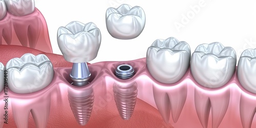 Dental implant in the gum