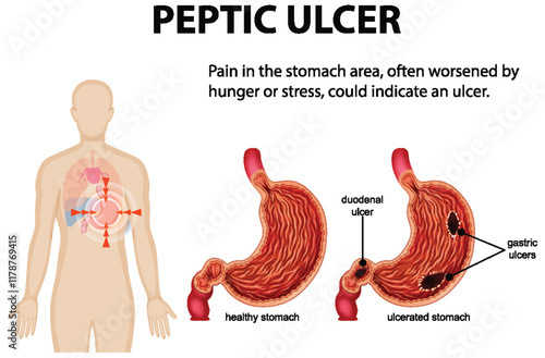 Understanding Peptic Ulcers and Stomach Pain