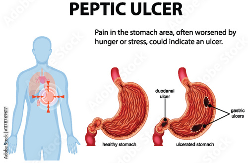 Understanding Peptic Ulcers and Symptoms