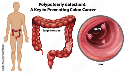 Understanding Colon Polyps and Prevention