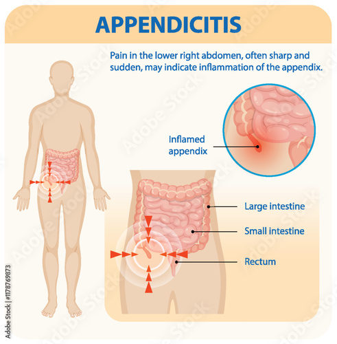 Understanding Appendicitis and Its Symptoms