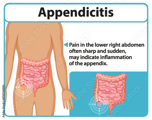 Understanding Appendicitis and Its Symptoms