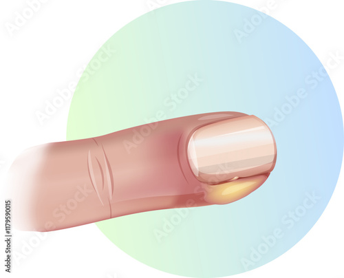 Finger Nail Infection - Illustration