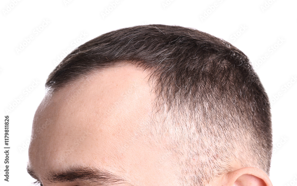 Obraz premium Baldness problem. Man with receding hairline on white background, closeup