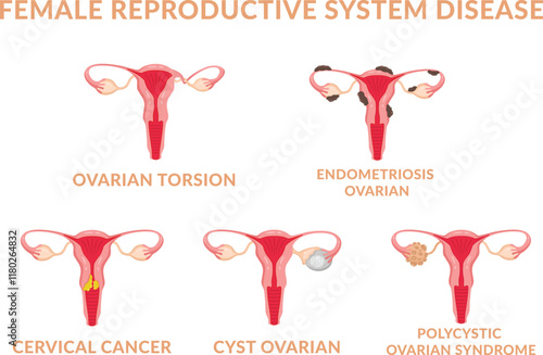 Female Reproductive System Disease, Endometriosis, Cyst, Torsion, Polycystic Ovarian Syndrome and Cervical Cancer 