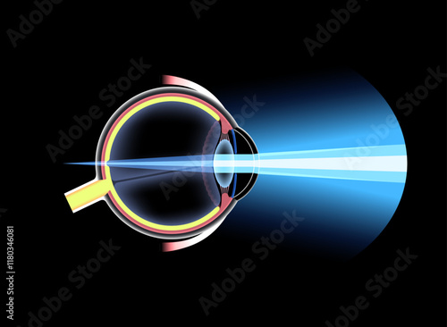 Farsightedness eye disease