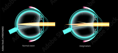Astigmatism eye disease