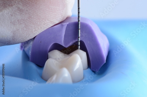 Foto Immediate Dentin Sealing with Rubber Dam
High-quality images showcasing the process of immediate dentin sealing performed under rubber dam isolation