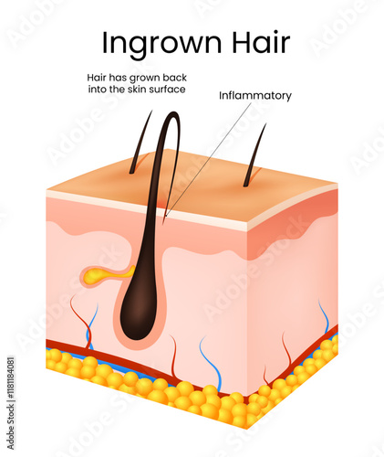 Symptoms of the Ingrown Hair