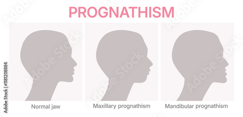 Vector illustration showing deformities of mandibular. Prognathism infographic. Orthognathic surgery.