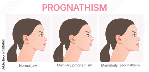 Vector illustration showing deformities of mandibular. Prognathism infographic. Orthognathic surgery.