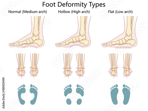 foot deformity types, normal arch, hollow high arch, and flat low arch, anatomical and footprint views diagram hand drawn schematic vector illustration. Medical science educational illustration