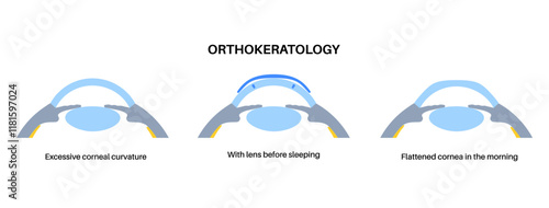 Orthokeratology contact lens