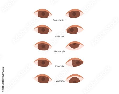 Strabismus eye disease