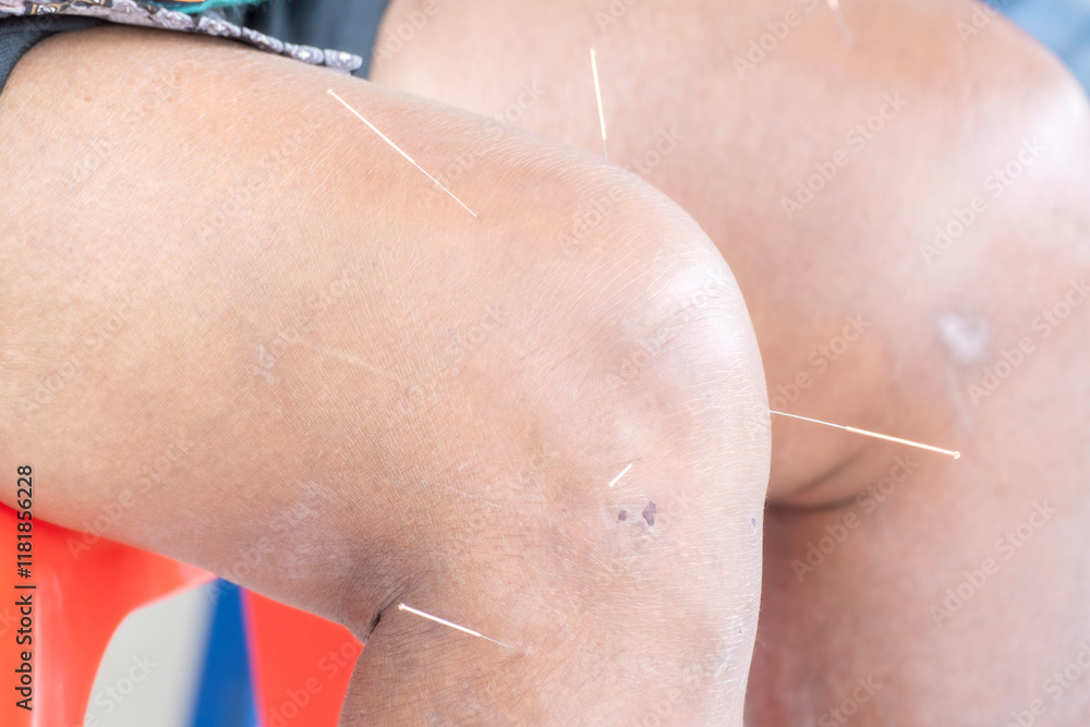 Fototapeta premium Chinese medicine acupuncture needle doctor traditional. close-up of several detailed into the skin body acupuncture treatment. alternative healing therapy relaxing muscle and pain in the clinic.
