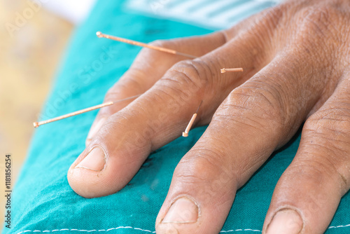 Chinese medicine acupuncture needle doctor traditional. close-up of several detailed into the skin body acupuncture treatment. alternative healing therapy relaxing muscle and pain in the clinic. photo