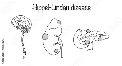 Hippel–Lindau disease