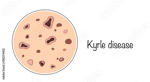 Kyrle disease