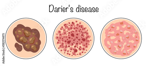 Darier's disease