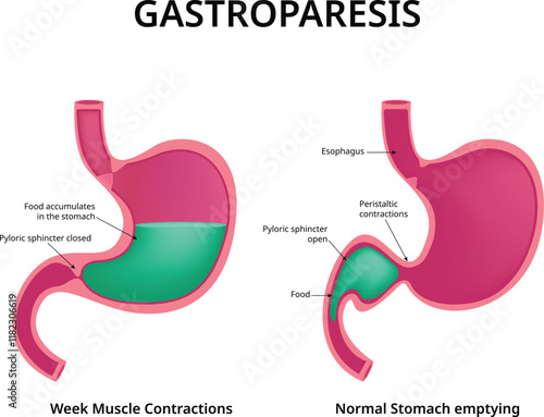 Gastroparesis Vector Design Illustration