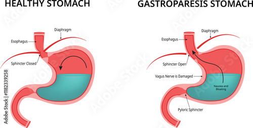 Healthy Stomach Gastroparesis Stomach Design Illustration