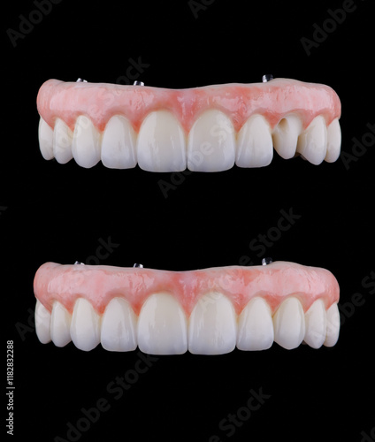 Full contour dental zirkonium prosthesis on titanium bar with removable canine stained by stains. photo