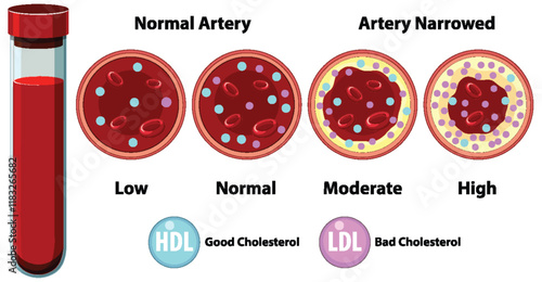 Understanding Artery Health and Cholesterol Levels