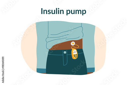 Concept of diabetes treatment, insulin pump. Medical equipment for insulin ijections on the human body. Vector hand drawn clipart.