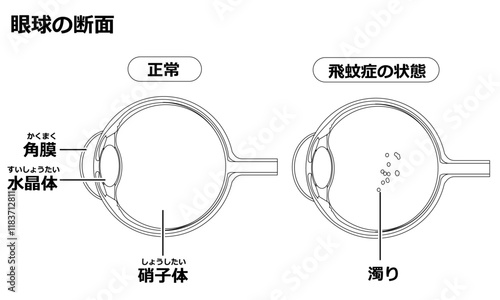飛蚊症（白黒）