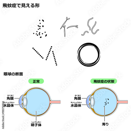 飛蚊症の状態